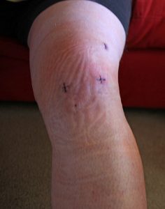 Typical scars from a knee scope
