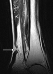 MRI showing tendon rupture (break in the darker color) due to use of cipro!