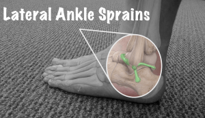 lateral ankle sprain is best treated by physical therapy in huntsville alabama at physioworks sports and wellness